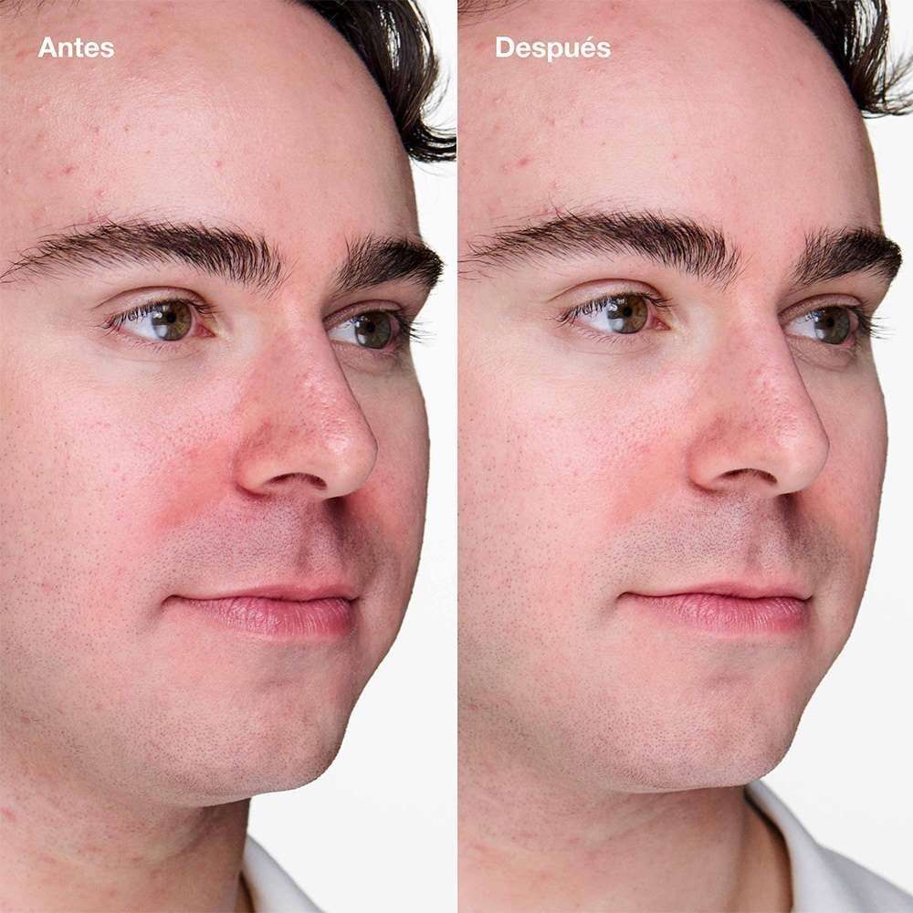 TRATAMIENTO EN GEL PARA PUNTOS NEGROS Y ACNE DE CLINIQUE (GEL CON &Aacute;CIDO SALIC&Iacute;LICO)